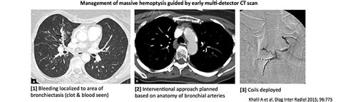 Severe hemoptysis - EMCrit Project