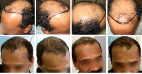 How Accelerated Follicular Restoration™ (AFR™) Reduces the Length of the Telogen (Dormancy ...