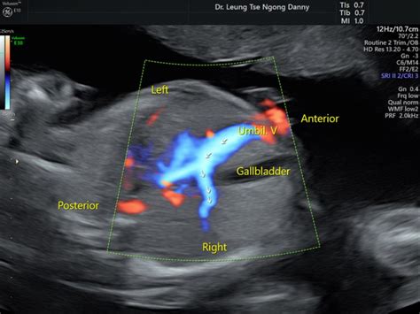 Persistent right umbilical vein - HKOG-INFO