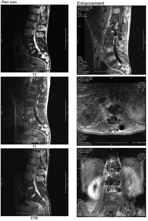 Lumbar vertebrae magnetic resonance imaging (MRI) showing abnormal... | Download Scientific Diagram