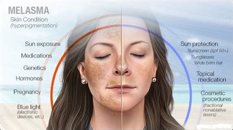 Melasma- Symptoms, Causes, Types, Cost & Laser Treatment