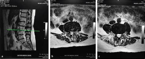 Minimally Invasive Laminectomy for Lumbar Stenosis | Neupsy Key