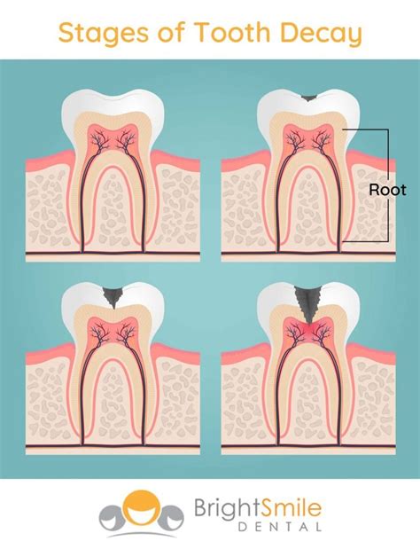 Most Common Root Canal Symptoms - Bright Smile Dental Powell