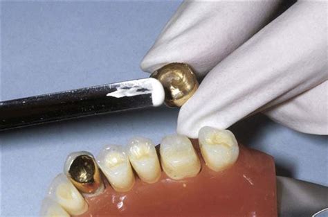 45. Dental Cements | Pocket Dentistry