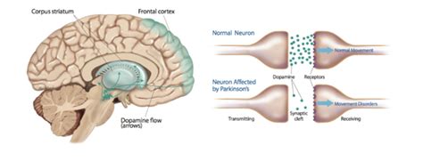 Glossary of Parkinson's disease - Summit for Stem Cell