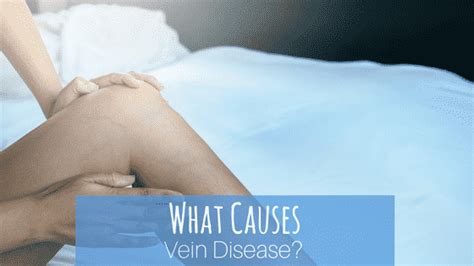 What Causes Vein Disease? - Summit Skin Care