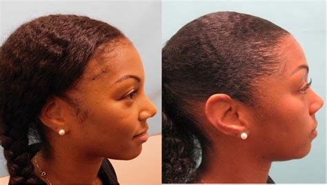 Traction Alopecia Case Study - Hair Loss At Edges - Hair Transplant Case Study - McGrath Medical