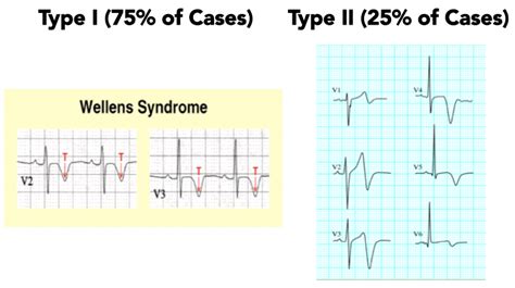 Wellens Syndrome: A Historical Literature Review – Dr. Jason West