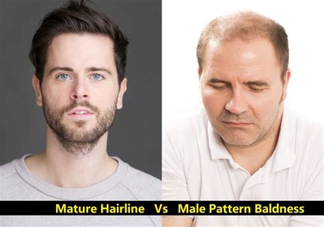 Maturing Hairline Vs. Receding Hairline: What Are The Differences ...