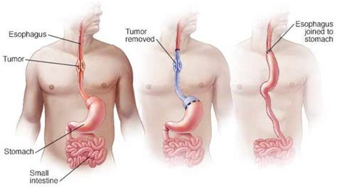 Esophagectomy in India: Causes, Procedure, Hospitals