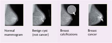 Pictures of Breast Cancer Lumps: How To Identify Warning Signs