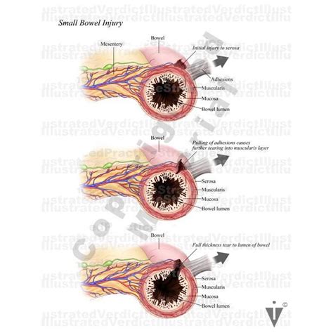 Stock Bowel: Anomalies / Obstructions / Injuries — Illustrated Verdict