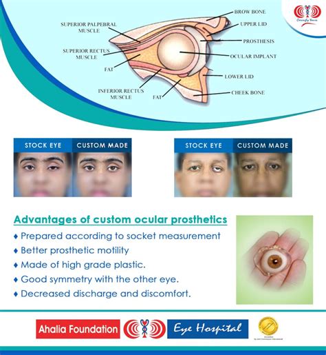 Prosthetic Eye - Ahalia Foundation Eye Hospital