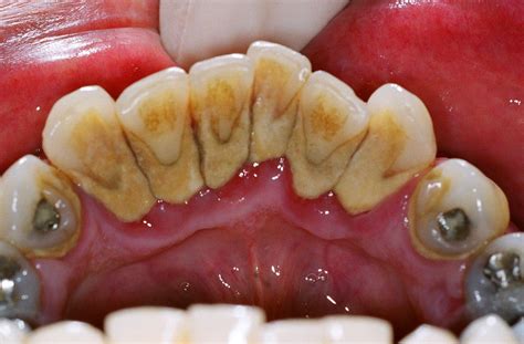 Is Dental Plaque the Main Cause of Dental Caries? | Intelligent Dental