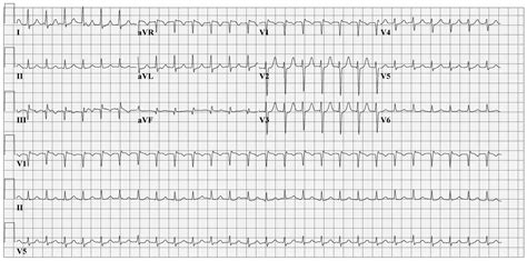 File:Avnrt ecg2.jpg - ECGpedia