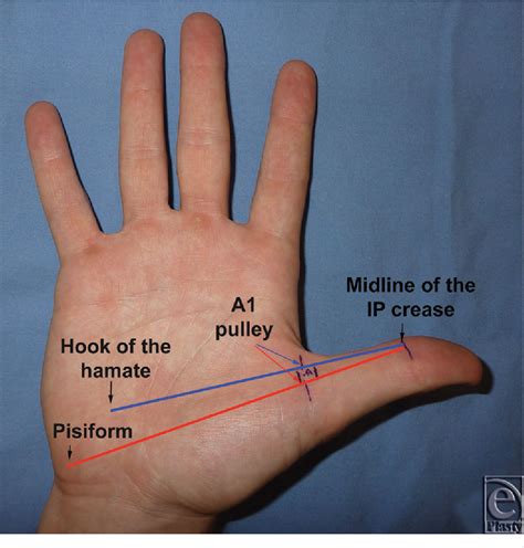 Figure 1 from Safe Treatment of Trigger Thumb With Longitudinal Anatomic Landmarks | Semantic ...