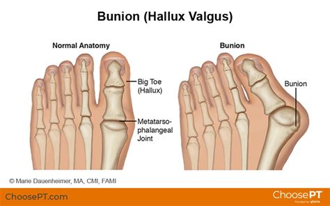 Guide | Physical Therapy Guide to Bunion (Hallux Valgus) | Choose PT