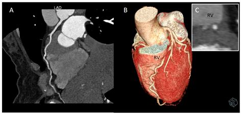 JCM | Free Full-Text | Myocardial Bridging: Review on the Role of ...