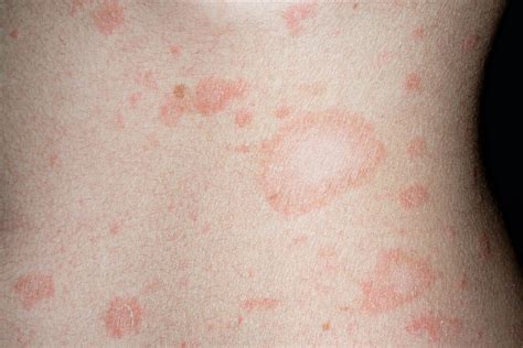 Pityriasis rosea – Bild kaufen – 11700170 Science Photo Library