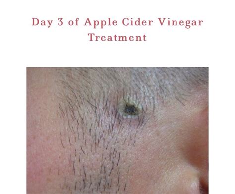 " How To Remove A Mole With Apple Cider Vinegar" | Trusper