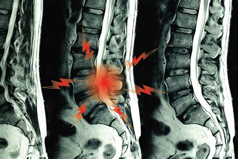 Trying to Figure Out If It's Spondyloarthritis? Don't Rely on MRIs