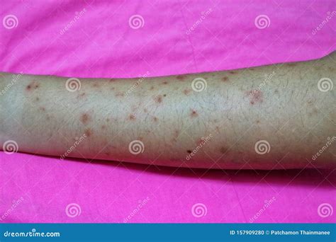 Close-up of the Skin on the Arm of Women with Skin Diseases, Allergies, Rash, Redness, Itching ...