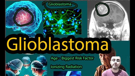 Glioblastoma - Symptoms, causes and new hope! - YouTube