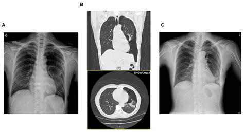 Iatrogenic Pneumothorax during Acupuncture: Case Report