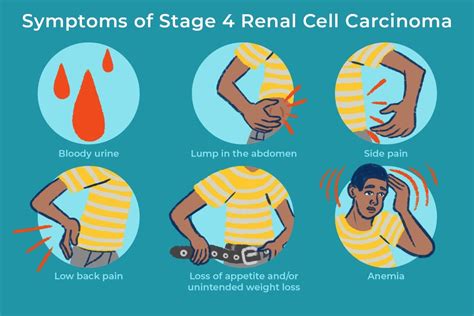 Renal Cancer: Causes, Stages, Symptoms & Treatments - Page 2 of 2