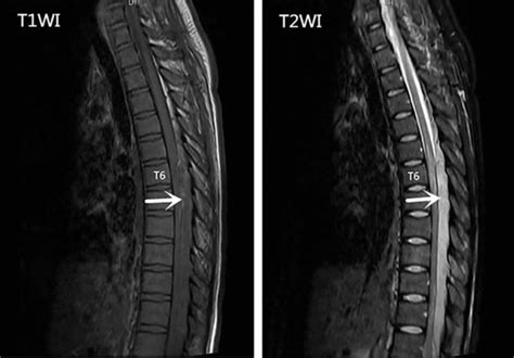 Epidural abscess causes, symptoms, diagnosis, treatment & prognosis