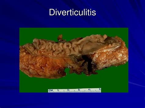 PPT - Inflammatory Bowel Disease, Diverticulitis, and Inflammatory Bowel Disease PowerPoint ...