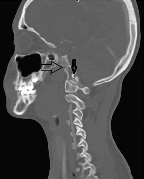 Occipital Condyle Fracture Extending to the Inferior Part of the Clivus ...