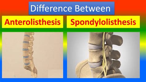 Distinction Between Anterolisthesis and Spondylolisthesis - YouTube