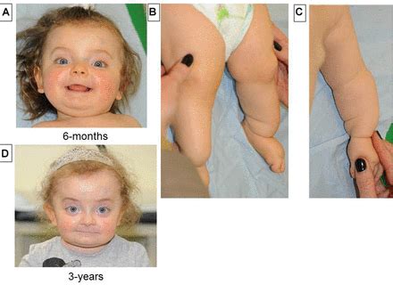 P4HB recurrent missense mutation causing Cole-Carpenter syndrome | Journal of Medical Genetics