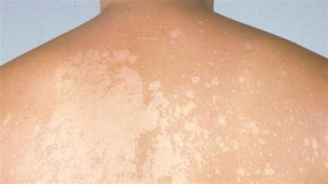 What causes white spots on skin