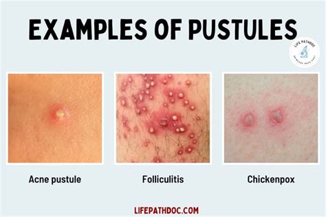 Papule vs Pustule vs Nodule: Pictures, Differences, and Causes