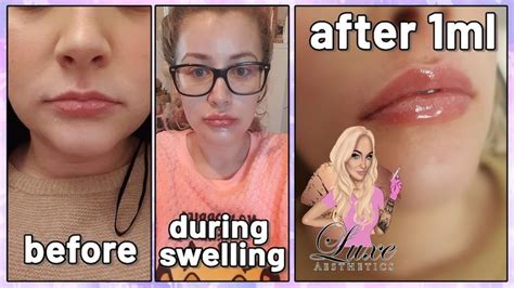 NATURAL Lip Filler Experience | 1ml Before and After Lip Injections ...