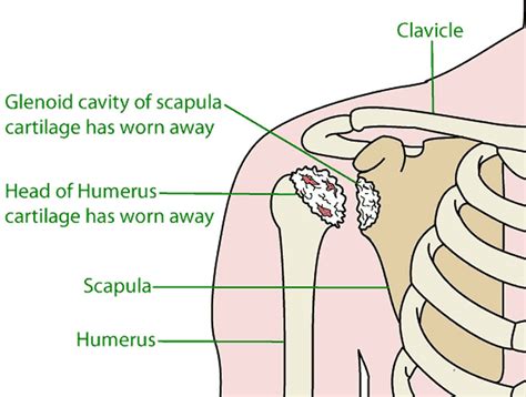 Glenohumeral arthritis causes, symptoms, diagnosis & treatment