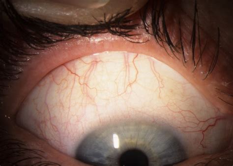 (a) Superior limbic keratoconjunctivitis (SLK); (b) Appearance of... | Download Scientific Diagram