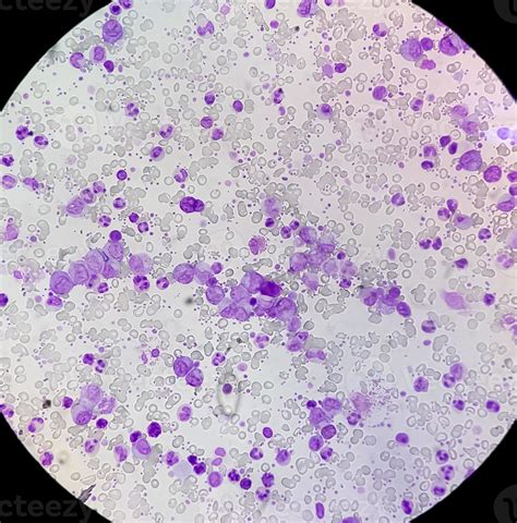 frottis sanguin de thrombocytose essentielle montrant un volume anormal ...