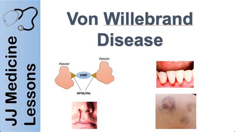 Von Willebrand Disease | Pathophysiology, Types, Symptoms and Treatment - YouTube