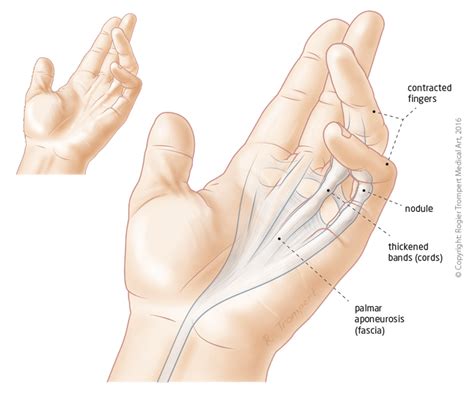 Dupuytren’s contracture - Hand Surgery – Hand Specialist | Montreal & Ottawa | Clinic ...