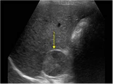 Abdomen and retroperitoneum | 1.10 Adrenal glands : Case 1.10.3 ...