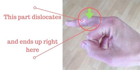 Treating & Training After A Finger Dislocation (Guide) | Injury Health Blog