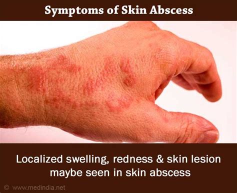 Boils | Skin Abscess - Causes, Symptoms, Diagnosis, Treatment