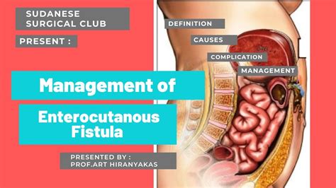 Management of Enterocutaneous Fistula - YouTube