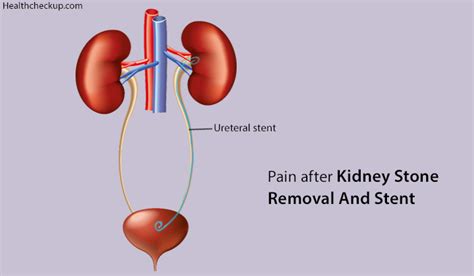 Pain after Kidney Stone Removal and Stent – Causes, Symptoms, Treatment by Dr Himanshi