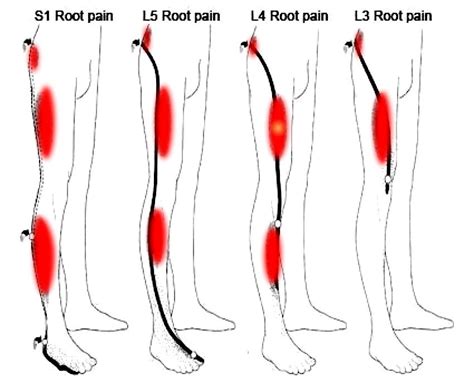 Sciatica? Similar Symptoms, Different Causes - StudyPK