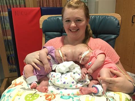 Conjoined Mooresville twins doing well after separation | News | mooresvilletribune.com