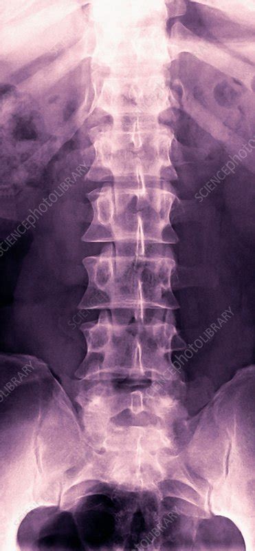 Normal lumbar spine, X-ray - Stock Image - F001/2975 - Science Photo ...